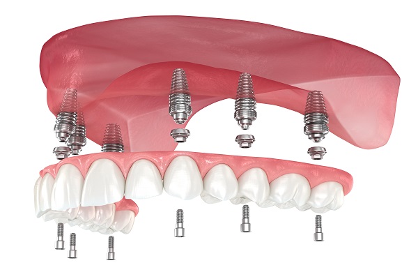 Implant Supported Dentures: Can They Successfully Replace Upper Teeth?