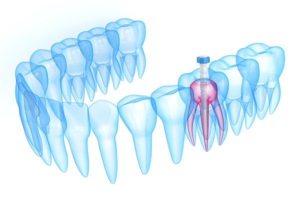 How Root Canals Save Your Natural Tooth